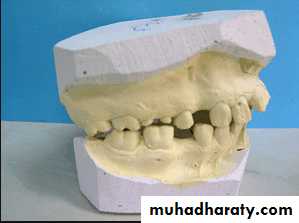 diagnosis and treatment plane for RPD-part 2