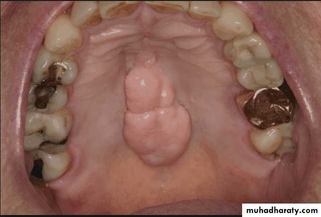 diagnosis and treatment plane for RPD-part 2