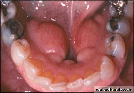 diagnosis and treatment plane for RPD-part 2