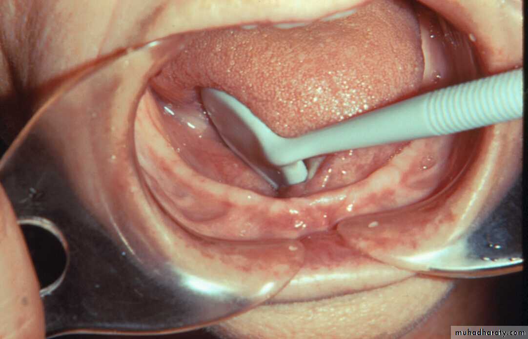 diagnosis and treatment plane for RPD-part 2