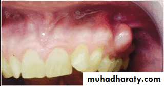diagnosis and treatment plane for RPD-part 2