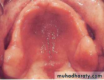 diagnosis and treatment plane for RPD-part 2