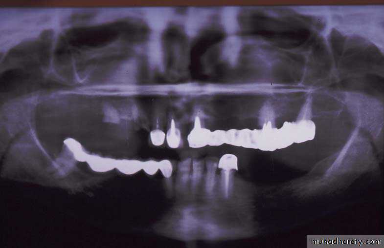 diagnosis and treatment plane for RPD-part 2
