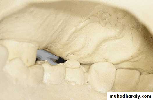 diagnosis and treatment plane for RPD-part 2