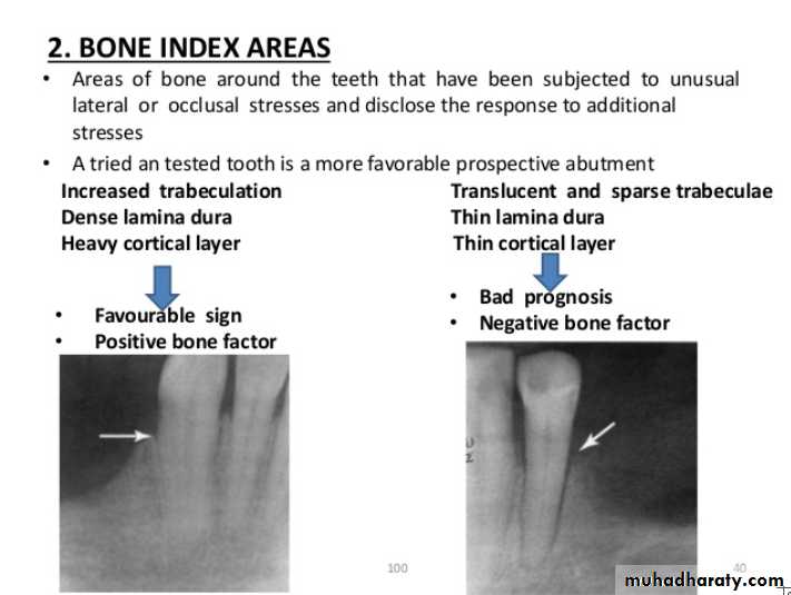 diagnosis and treatment plane for RPD-part 2