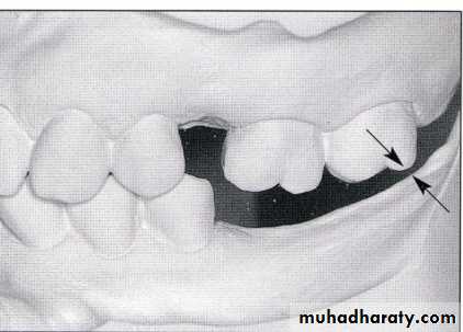 diagnosis and treatment plane for RPD-part 2