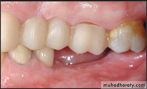 diagnosis and treatment plane for RPD-part 2