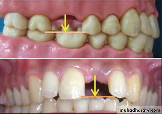 diagnosis and treatment plane for RPD-part 2