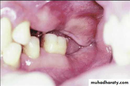 diagnosis and treatment plane for RPD-part 2
