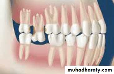 diagnosis and treatment plane for RPD-part 2