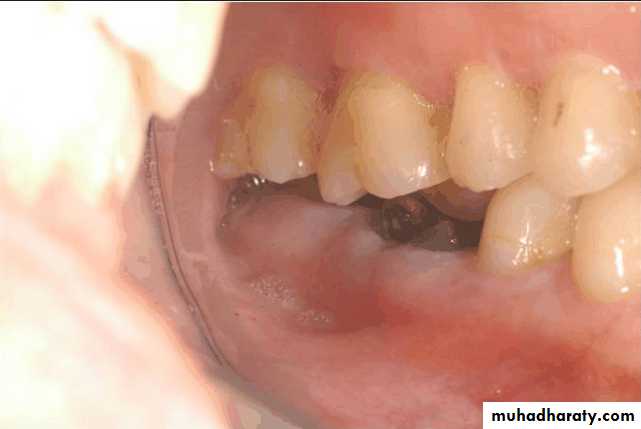 diagnosis and treatment plane for RPD-part 2