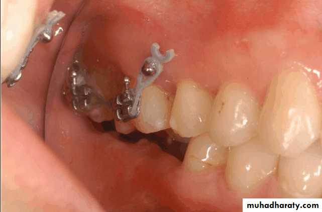 diagnosis and treatment plane for RPD-part 2