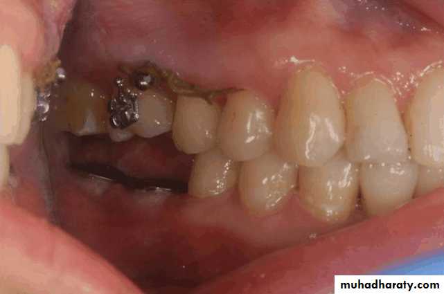 diagnosis and treatment plane for RPD-part 2