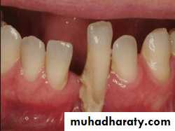 diagnosis and treatment plane for RPD-part 2