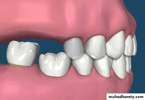 diagnosis and treatment plane for RPD-part 2
