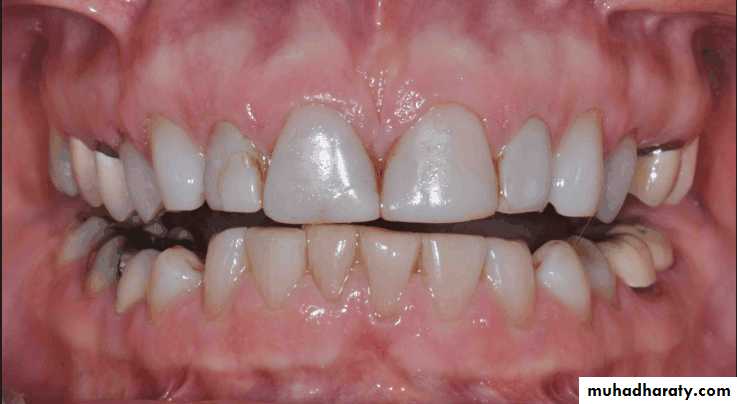 diagnosis and treatment plane for RPD-part 2