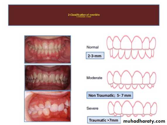 diagnosis and treatment plane for RPD-part 2