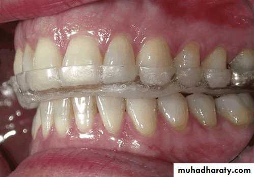 diagnosis and treatment plane for RPD-part 2