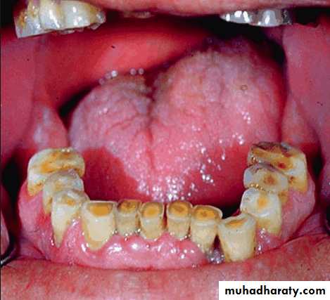 diagnosis and treatment plane for RPD-part 2