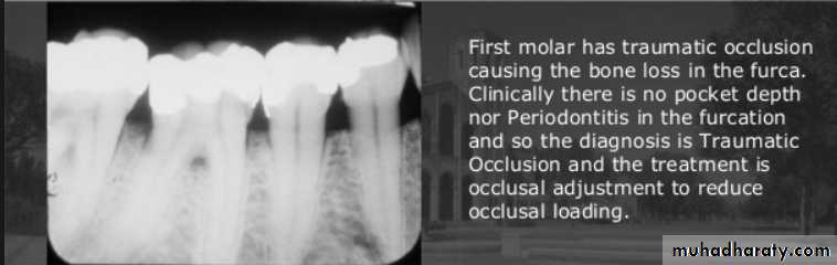 diagnosis and treatment plane for RPD-part 2