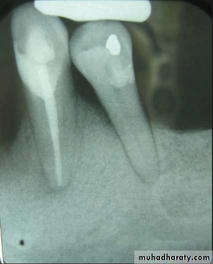 diagnosis and treatment plane for RPD-part 2