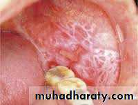dr asmaa red and white lesions