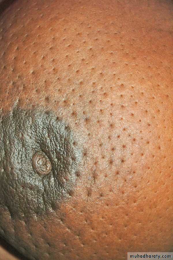 Breast