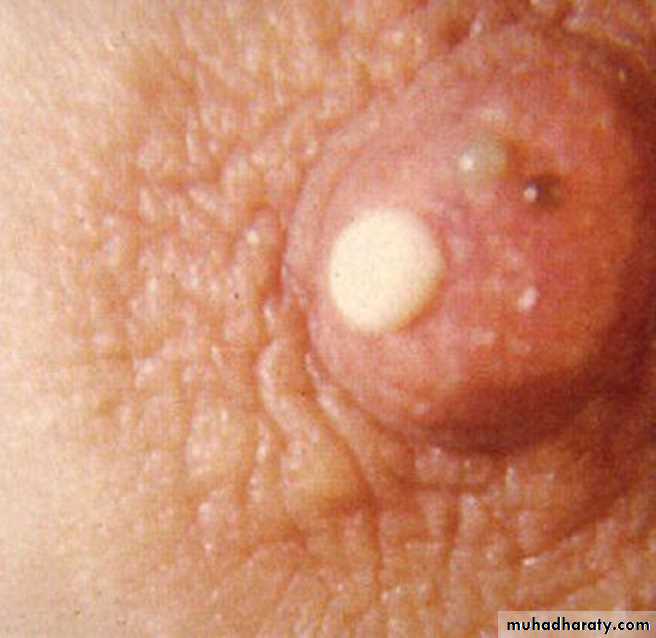 Breast