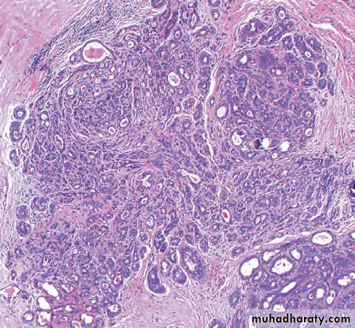 Breast pathology