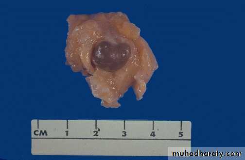 Breast pathology