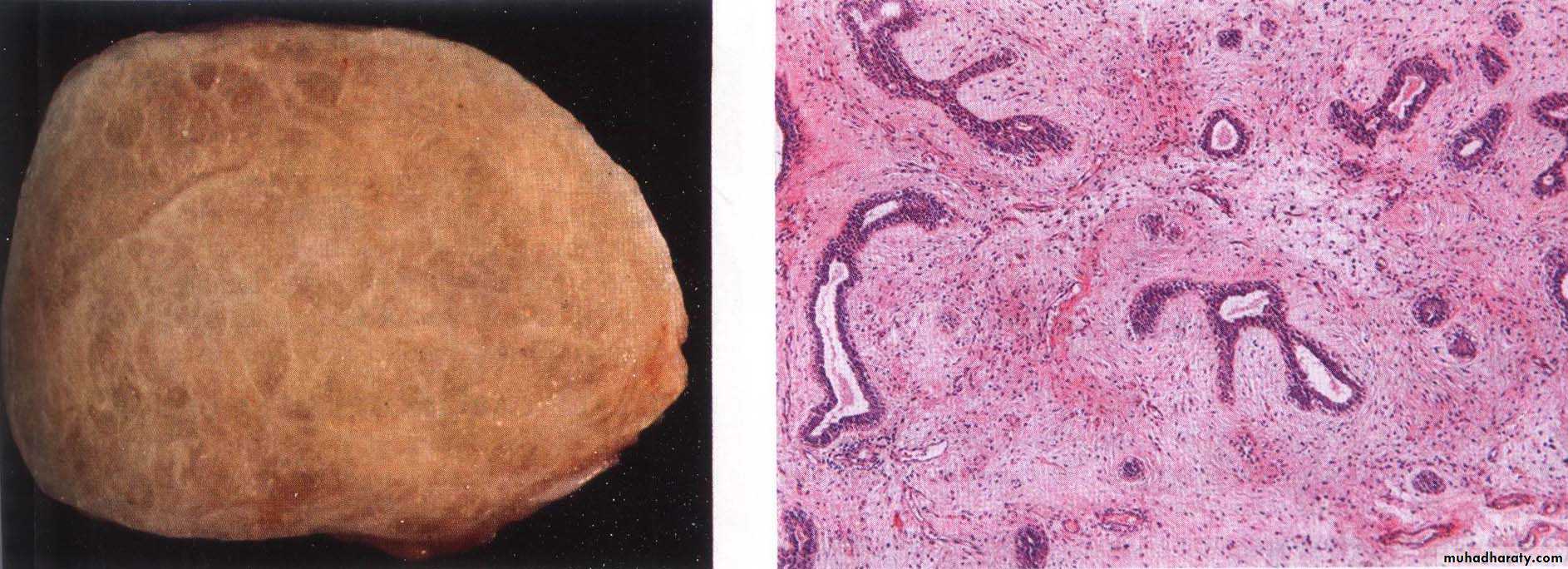 Breast pathology 2