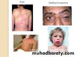 ALLERGY