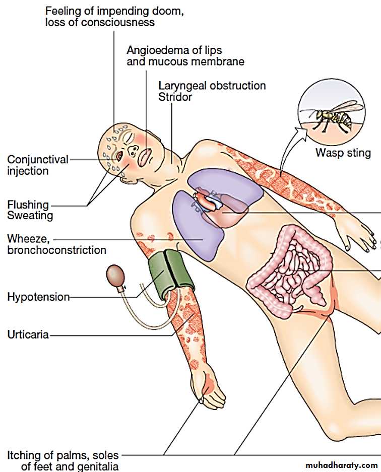 ALLERGY