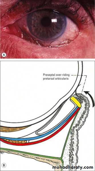 eye lid