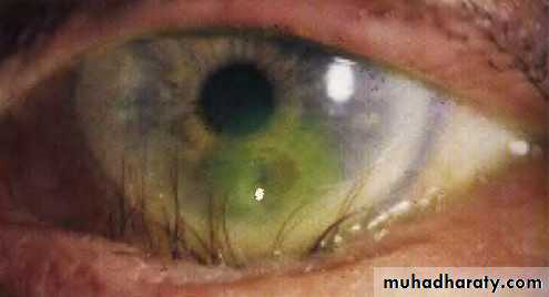eye lid