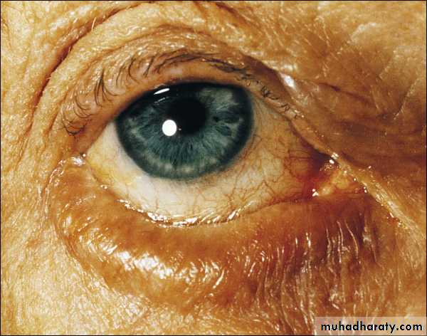 eye lid