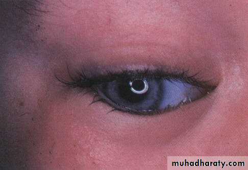 eye lid