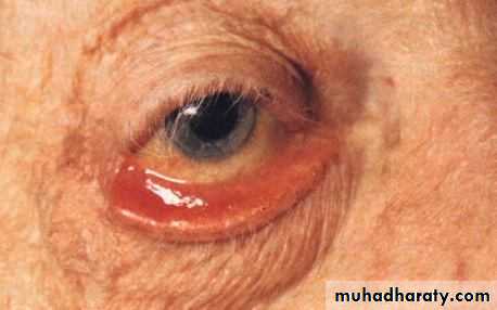 eye lid