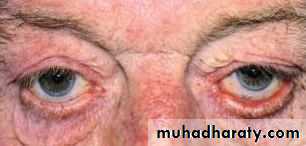 eye lid