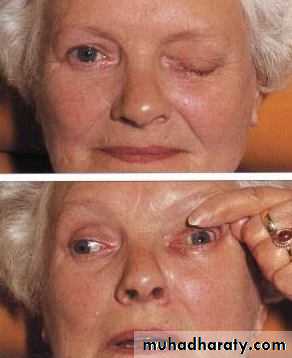 eye lid