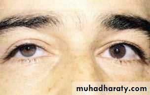 eye lid