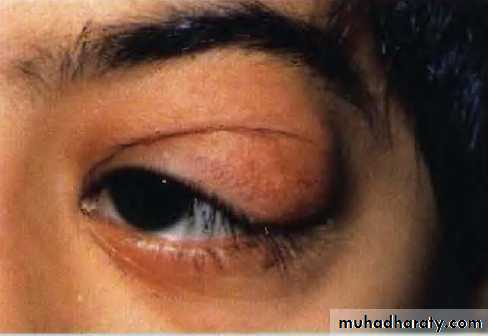 eye lid