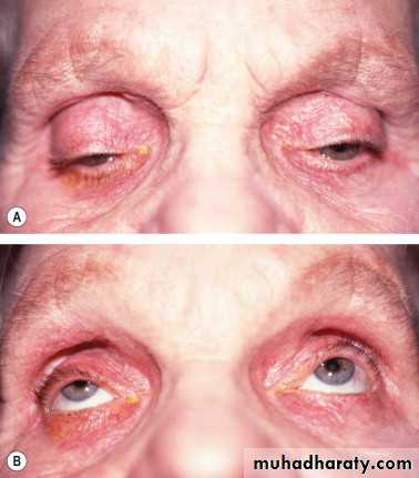 eye lid