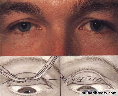 eye lid