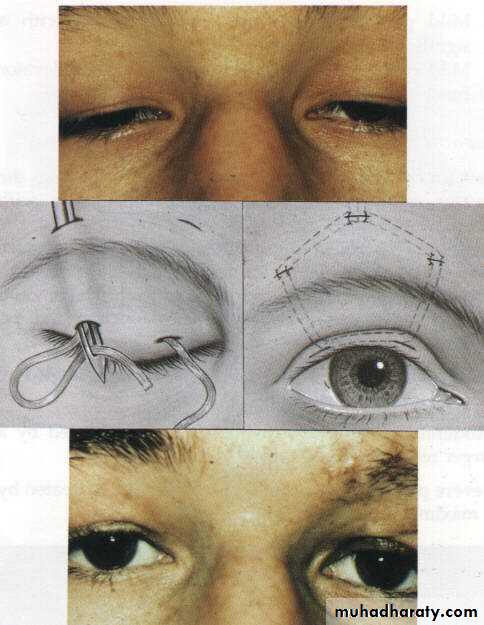 eye lid