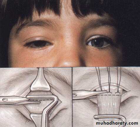 eye lid