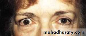 eye lid