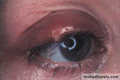 eye lid