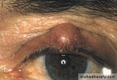 eye lid