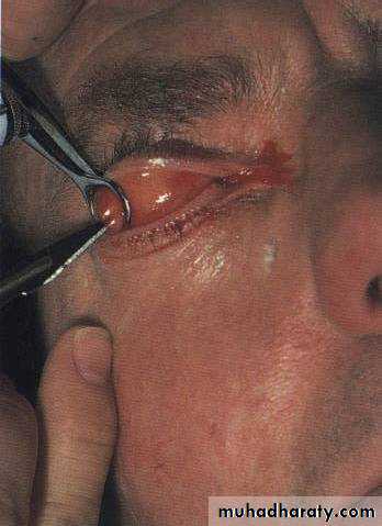 eye lid
